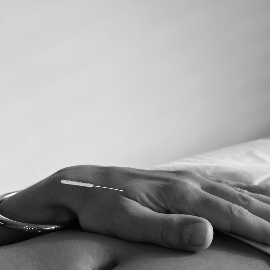 Acupuncture East Sussex